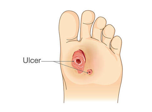 pressure ulcers